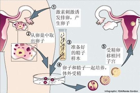 体外受精 IVF-ET